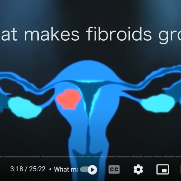 what causes fibroids to grow graphic