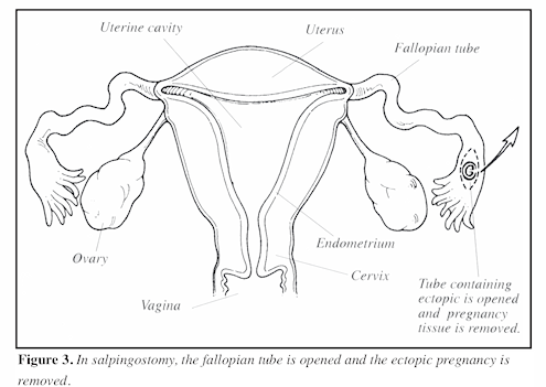Ectopic_Fig4.png
