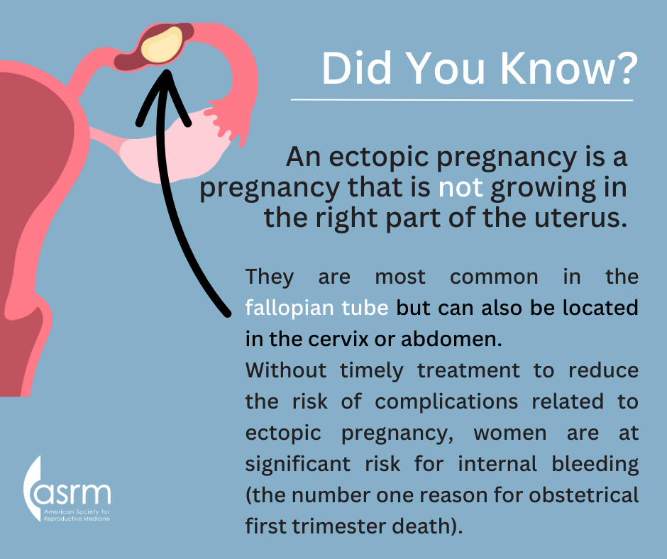 Ectopic Pregnancy Infographics