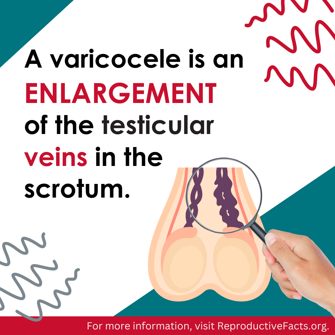 Varicocele is an enlarged vein in the scrotum